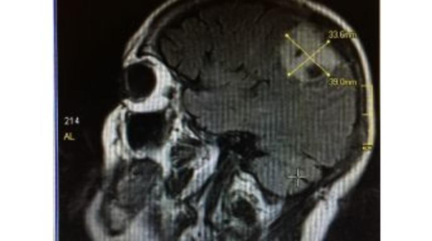 Konuşa Konuşa Beyin Ameliyatı