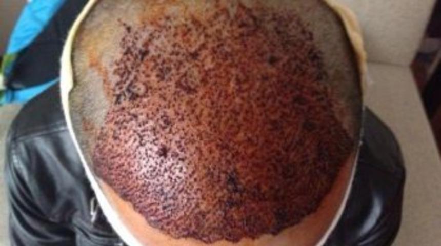 Yabancılar Sa&ccedil; Ekimi İ&ccedil;in T&uuml;rkiye&rsquo;yi Tercih Ediyor