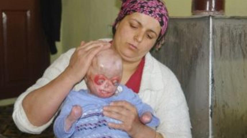 Yangında G&ouml;zlerini Ve Ellerini Kaybeden K&uuml;&ccedil;&uuml;k Serkan Yardım Bekliyor