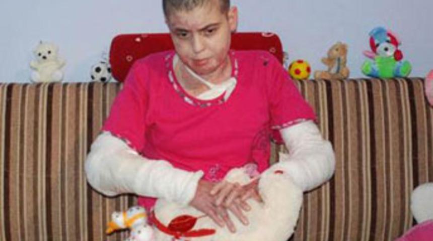 V&uuml;cudunun y&uuml;zde 85'i yanan kızın &ccedil;ilesi