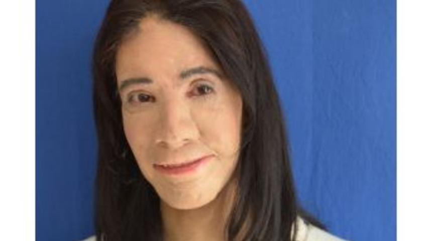 Gaziantepli Doktordan &Ccedil;ığır A&ccedil;acak Nakilsiz Y&uuml;z