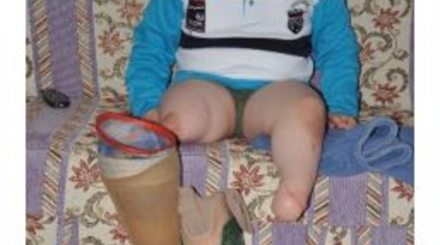 Sağlıklı Protez Yapılmazsa Minik Arda Kangren Olup Her İki Ayağını Birden Kaybedecek