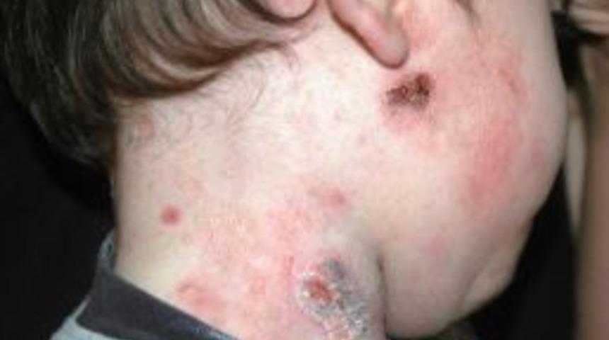 (&ouml;zel Haber) K&uuml;&ccedil;&uuml;c&uuml;k Bedeninde Kocaman Yaralarla M&uuml;cadele Ediyor