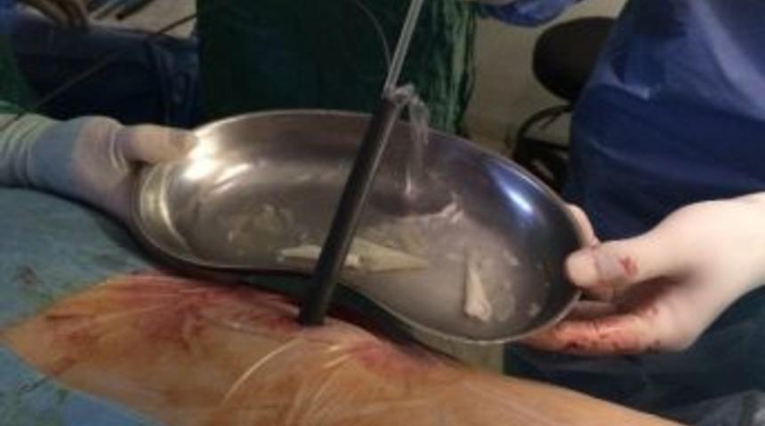 Bu Ameliyat Dünyada İkinci Kez, Türkiye’de İse İlk Defa Yapıldı