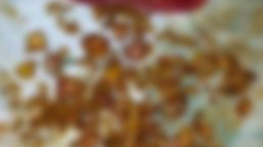 Karın Ağrısıyla Hastaneye Gitti Safra Kesesinden 683 Taş &Ccedil;ıktı