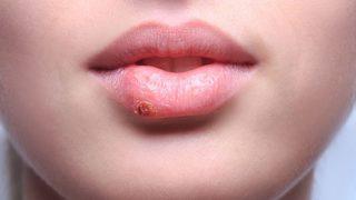 Uçuk nasıl geçer, ne iyi gelir? Uçuk tedavisi için evde uygulanabilecek doğal yöntemler işe yarar mı?