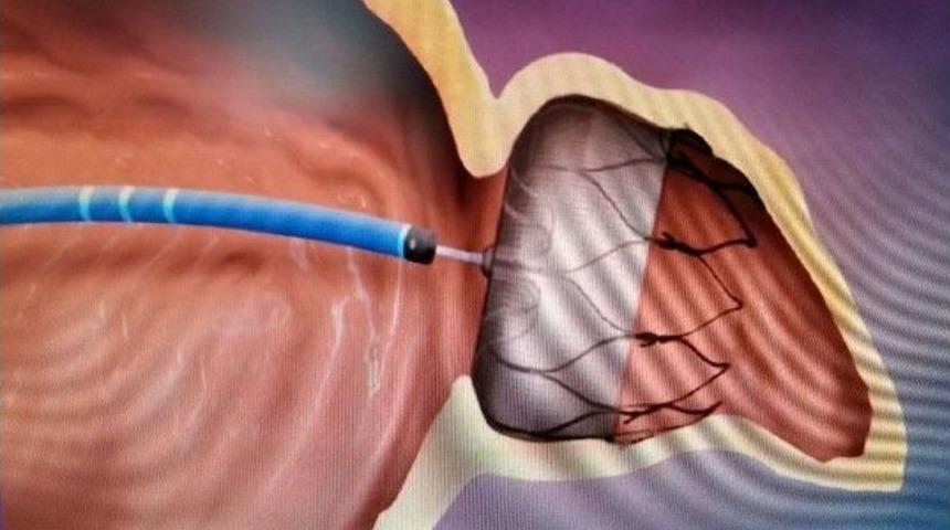 (&ouml;zel Haber) Kan Sulandırıcı İla&ccedil;lar Tarihe Karışacak