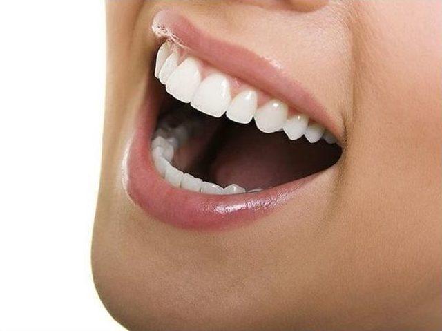 Lingual Ortodontiyle Diş Telleriniz Gülüşünüzü Bozmasın