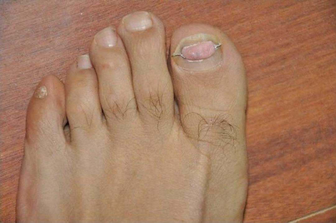 Tırnak Batmasına Telli Tedavi