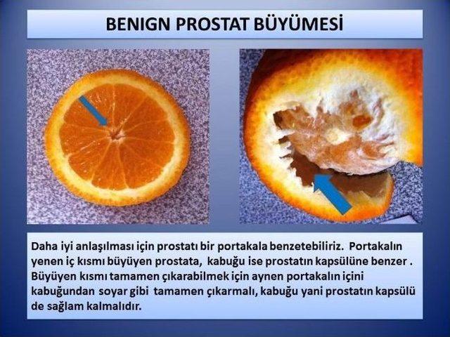 Prostat Ameliyatında Yeni Yöntem: Holep