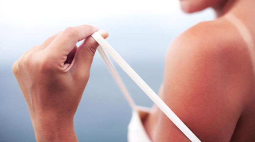 Güneş yanığına yoğurt sürmeyin!