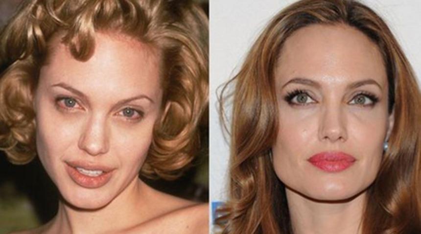 Burun estetiği yaptıran &uuml;nl&uuml;ler