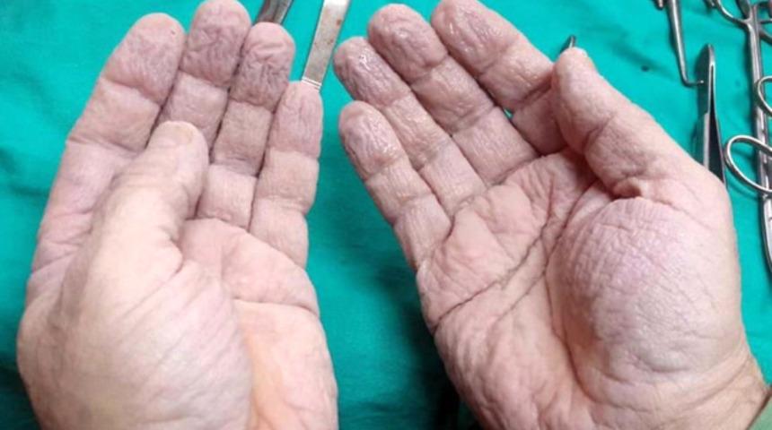 Ameliyat sonrası ellerini paylaşan doktor sosyal medyayı salladı