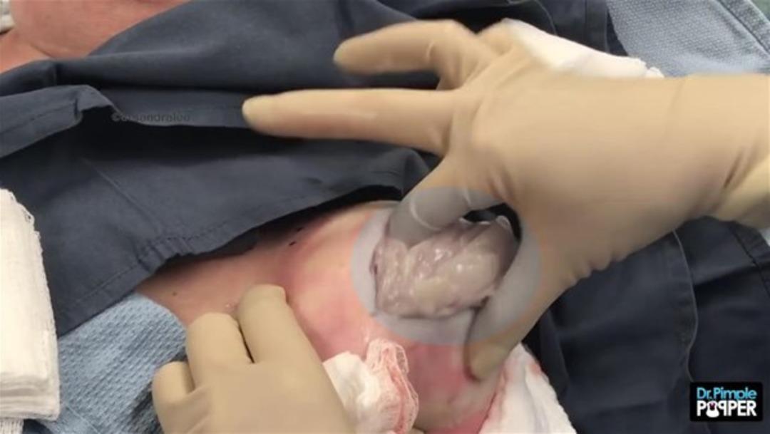 Omzundaki yağ bezesinden kurtulmak isteyince...