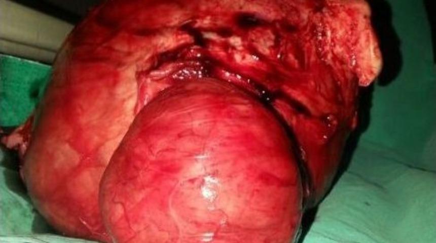 Karnından 4 Kilo 700 Gram Kitle &Ccedil;ıkarıldı