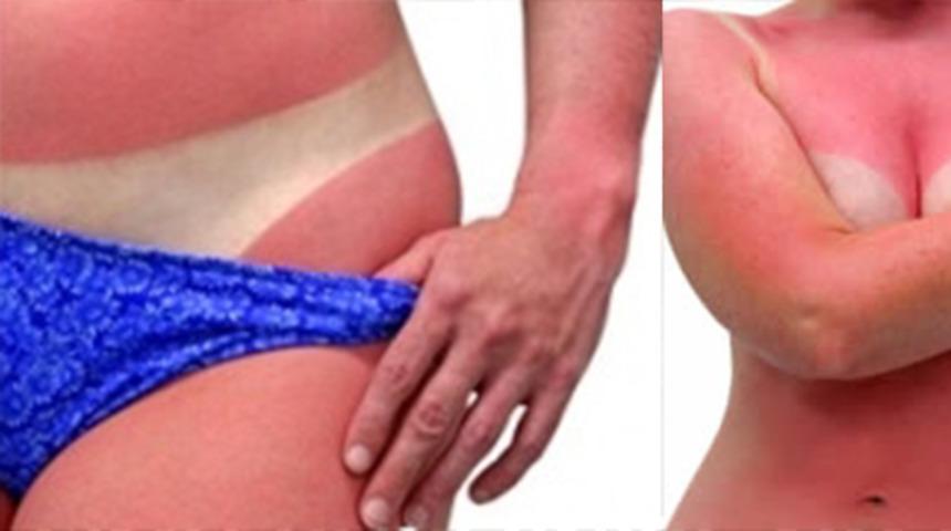 Beyaz tenliler güneşlenirken nelere dikkat etmeli?