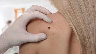 Cilt kanserine yakalanmak sandığınızdan çok daha basit! Cilt kanseri belirtileri nelerdir?