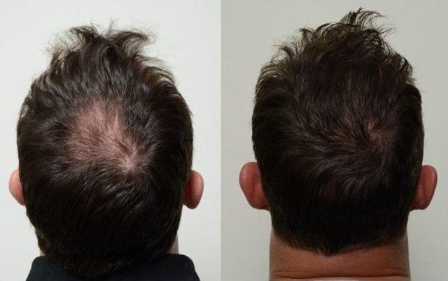 Sa&ccedil; D&ouml;k&uuml;lmesine Prp &Ccedil;&ouml;z&uuml;m&uuml; 2