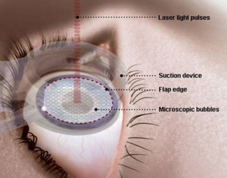 Лазерная коррекция зрения 2024. Глаза после коррекции зрения ласик. Глаза после лазерной коррекции. Лазерная операция на глаза. Лазерная коррекция зрения Femto LASIK.