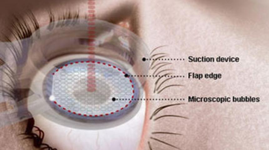 G&ouml;zde lazer tedavisiyle ilgili her şey!