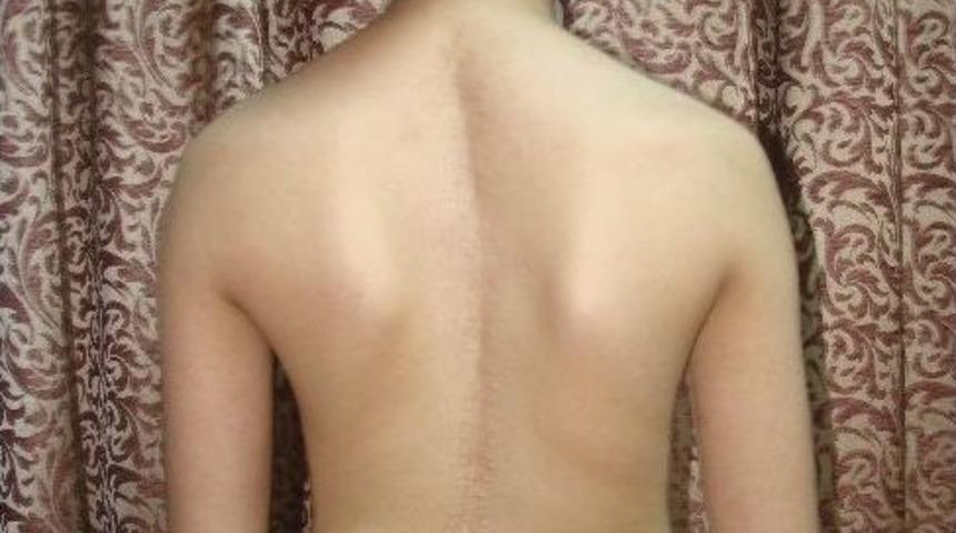 &Ouml;zalay: "duruş Bozukluğu Skoyloz Belirtisi Olabilir"