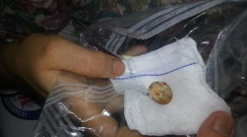 Safra Kesesinden &Ccedil;ıkan Taşın B&uuml;y&uuml;kl&uuml;ğ&uuml; Şaşırttı