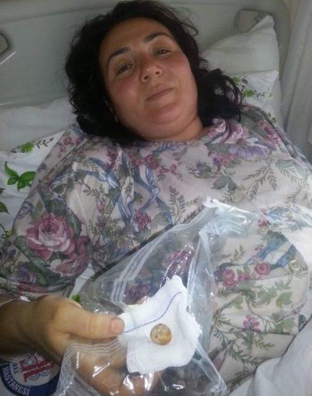 Safra Kesesinden &Ccedil;ıkan Taşın B&uuml;y&uuml;kl&uuml;ğ&uuml; Şaşırttı 1