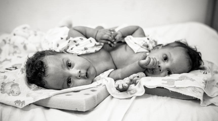 Sadece yapışık ikizlerin fotoğraflarını &ccedil;ekiyor...