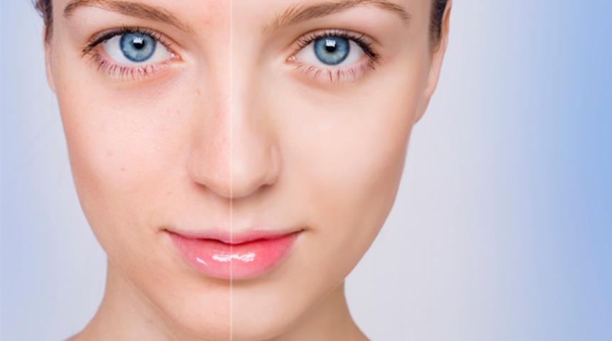 Kahverengi lekeleri ge&ccedil;iren y&ouml;ntemler ve maske tarifleri