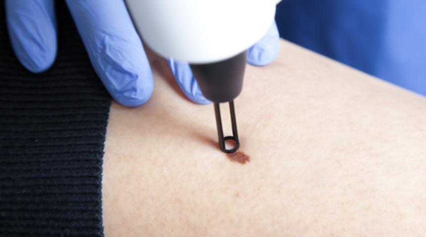 Tatil dönüşü benlerinizi kontrol ettirin