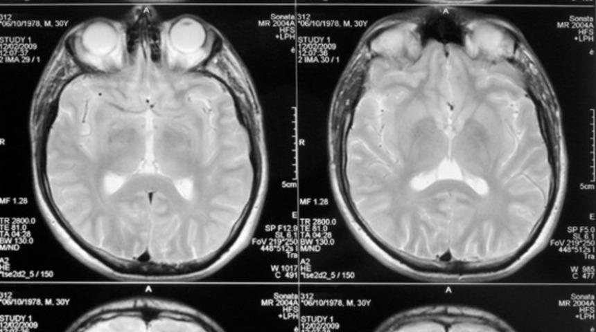 İngiltere'de sürekli epilepsi nöbeti geçiren 8 yaşındaki kızın beyninden 100 tane tenya yumurtası çıkarıldı! 