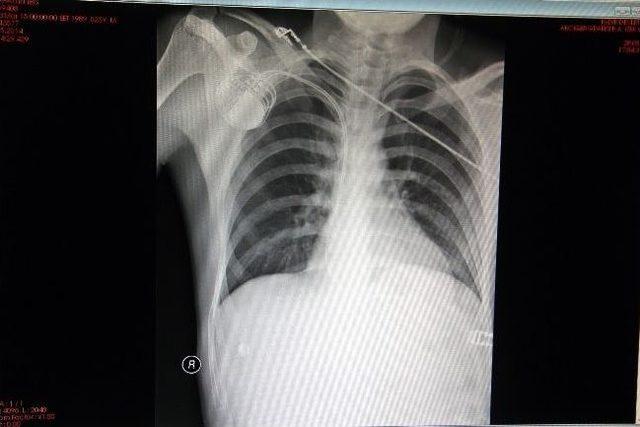 (&ouml;zel Haber) Iğdır&rsquo;da İlk Defa Bir Hastaya 2 Odacıklı Kalp Pili Takıldı 1