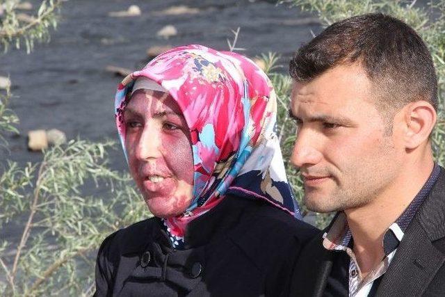 Y&uuml;z&uuml;n&uuml; Kaplayan Doğum Lekesi İ&ccedil;in Yardım Bekliyor 1