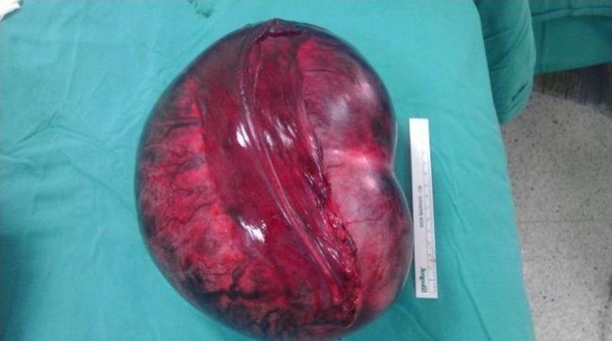 (özel Haber) Karnından 5 Kilo Kitle Çıkarıldı