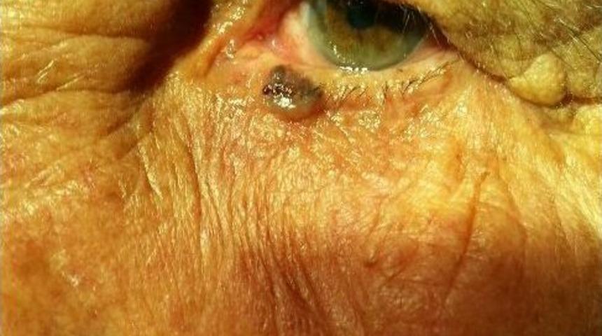 Elbistan'da G&ouml;z Alt Kapağı Ameliyatı