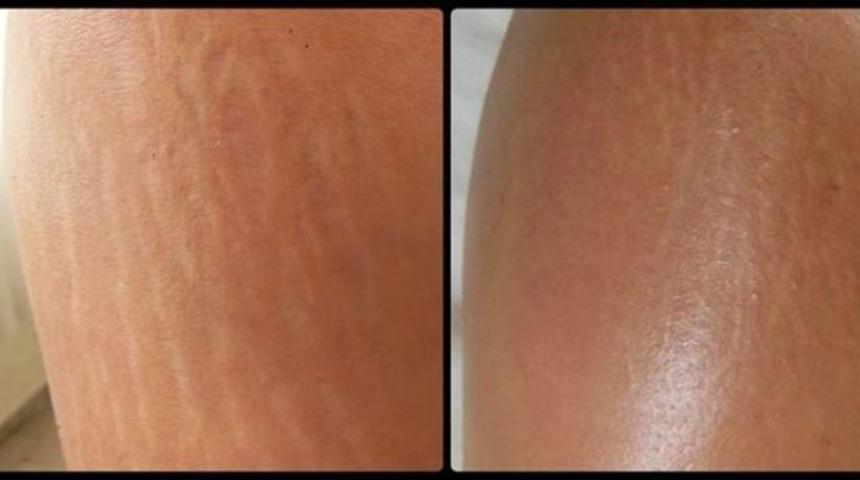 Çatlağı Olanlara Müjde