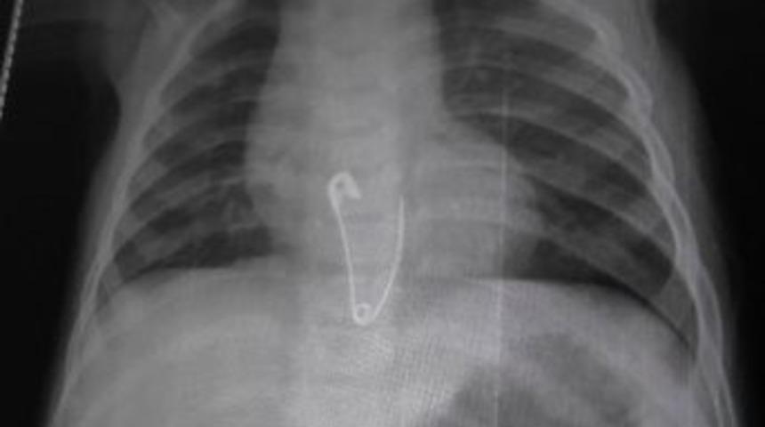 &Ccedil;engelli İğne Yutan 8 Aylık Bebek Hastanelik Oldu