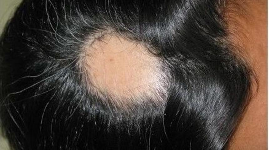 Sa&ccedil;kıranda En &Ouml;nemli Fakt&ouml;r Stres