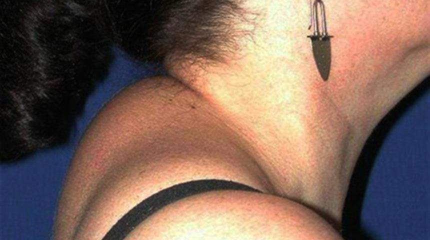   Cushing Sendromu tedavi edilmezse ölümle sonuçlanabilir