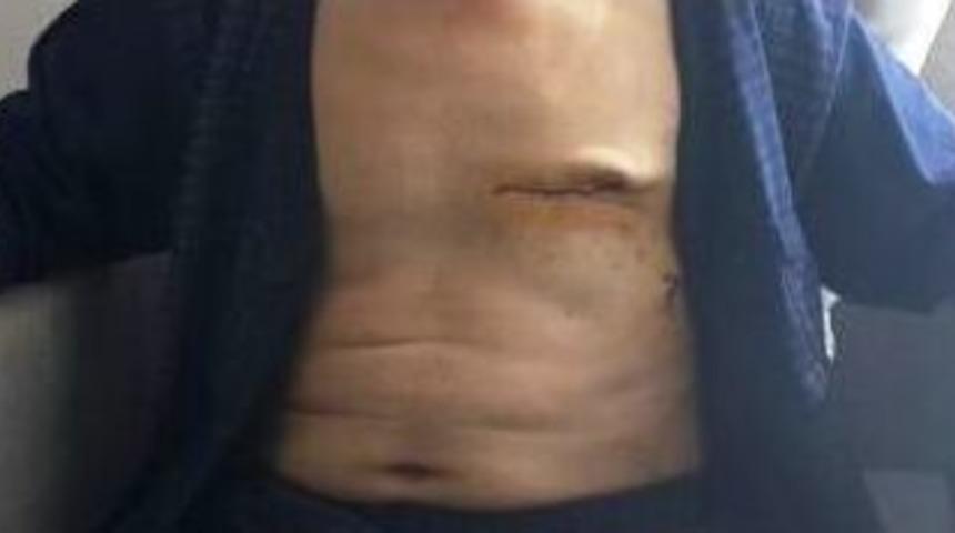 &Ouml;zel Medikar Hastanesinde K&uuml;&ccedil;&uuml;k Kesi Y&ouml;ntemi İle By-pass Ameliyatı