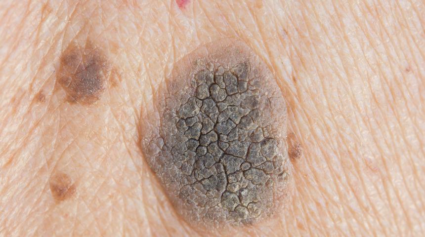 Deri kanserinde erken teşhis i&ccedil;in siğil, ben ve koyu renkli lekeleri takip edin