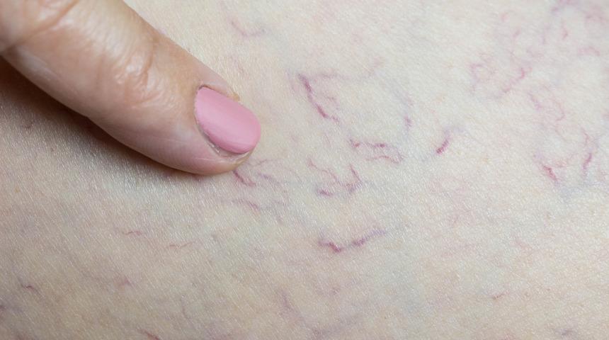 Varis neden olur? Varis tedavisi nasıl yapılır? Varis belirtileri nelerdir?