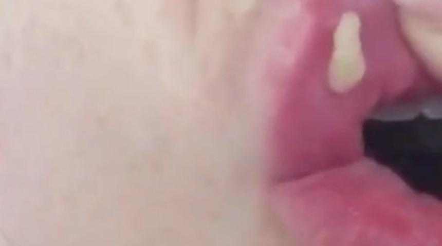 Ucuz &uuml;r&uuml;nlerin kullanıldığı  dudak dolgu malzemeleri bakın neye yol a&ccedil;ıyor! 