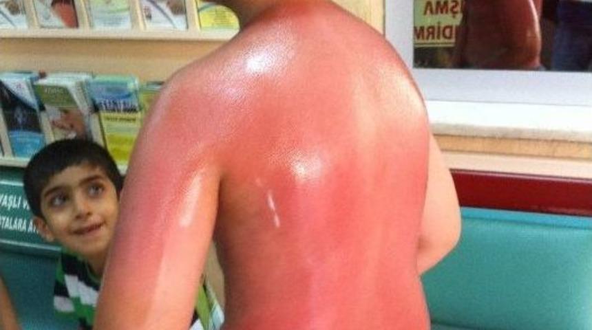 G&uuml;neş Altında Uzun S&uuml;re Bekleyince Hastanelik Oldu