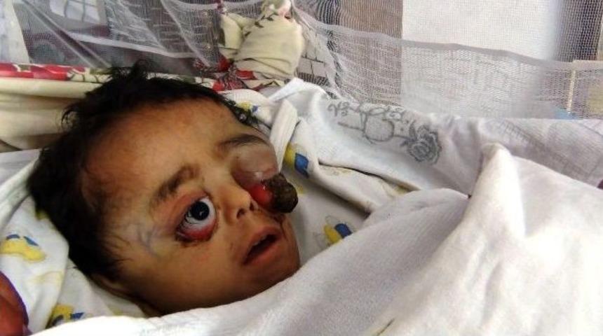 T&uuml;m&ouml;r Nedeniyle G&ouml;z&uuml; Dışarı Fırladı