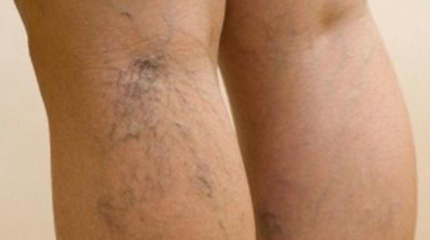 Varisinizden Kurtulun, Damarınızdan Değil!