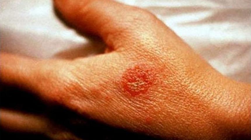 Egzama Şikayetleri Sıcak Havalarda Artıyor