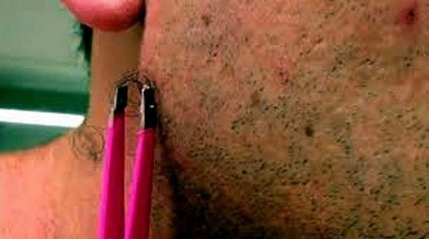 Kıl Dönmesi Acil Müdahale Gerektirebiliyor