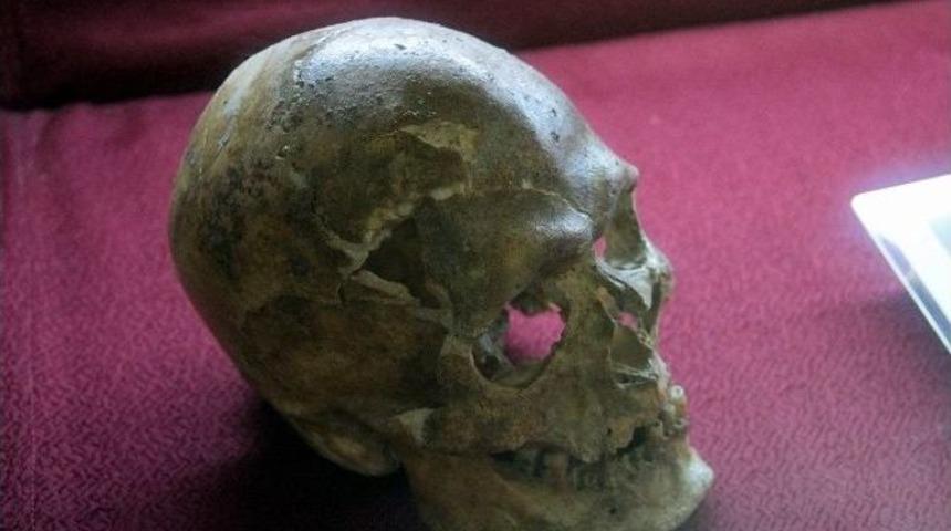 5 Bin Yıllık Beyin Ameliyatı