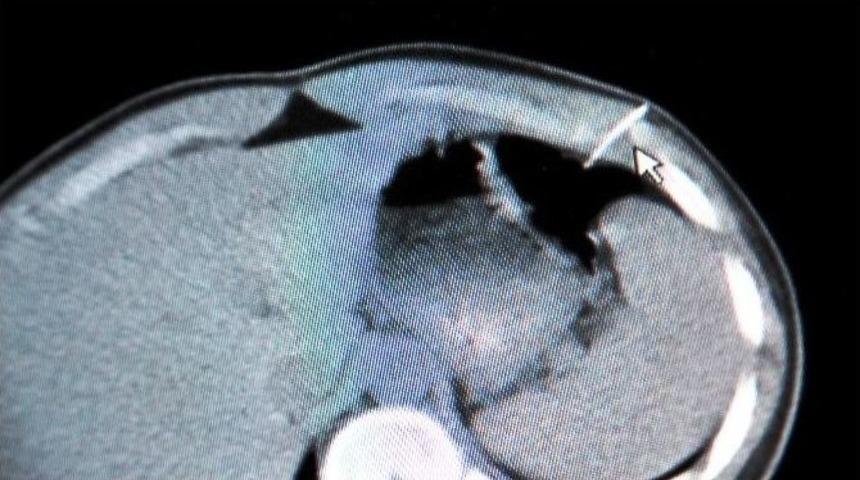 Enjekt&ouml;rl&uuml; Şaka Hastanede Bitti